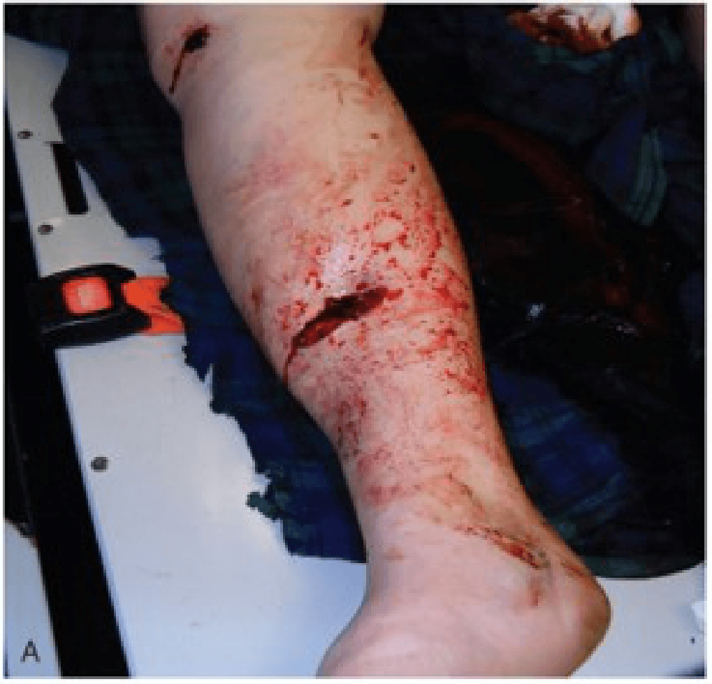 Imagen clínica de la pregunta de Traumatología y Cuidado de Heridas
